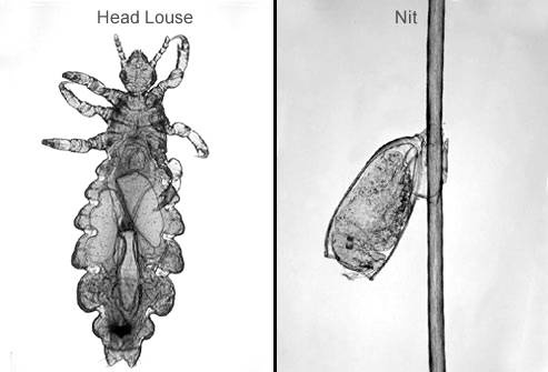 What to do if you get head lice