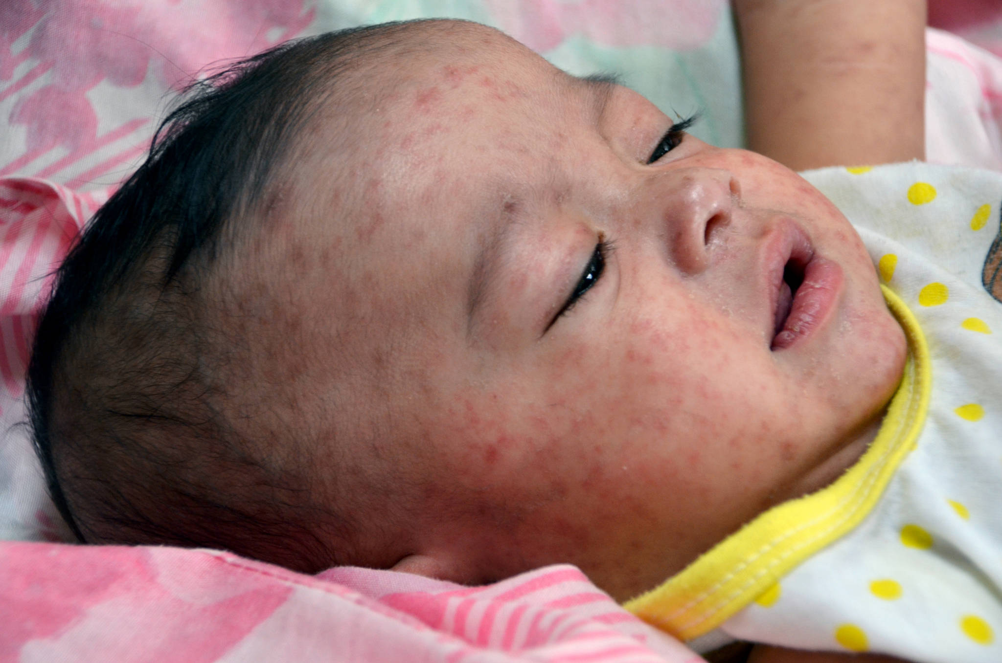 Jim Goodson photo/Centers for Disease Control                                A baby in the Philippines suffers from measles in a 2014 outbreak.