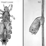 What to do if you get head lice